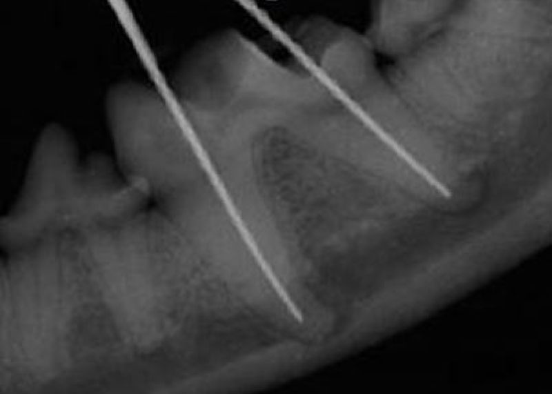 Endo X Ray tooth